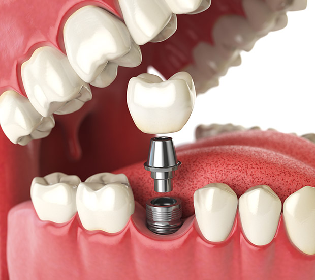 Cleburne Will I Need a Bone Graft for Dental Implants