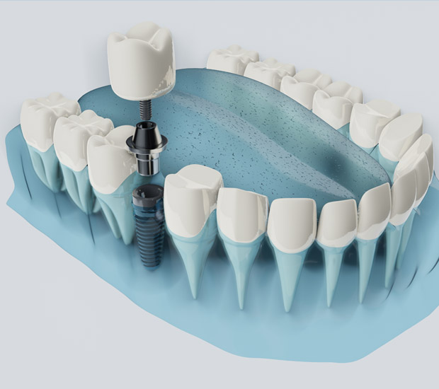 Cleburne Am I a Candidate for Dental Implants