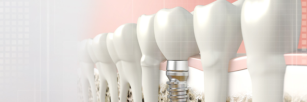Cleburne Dental Implants