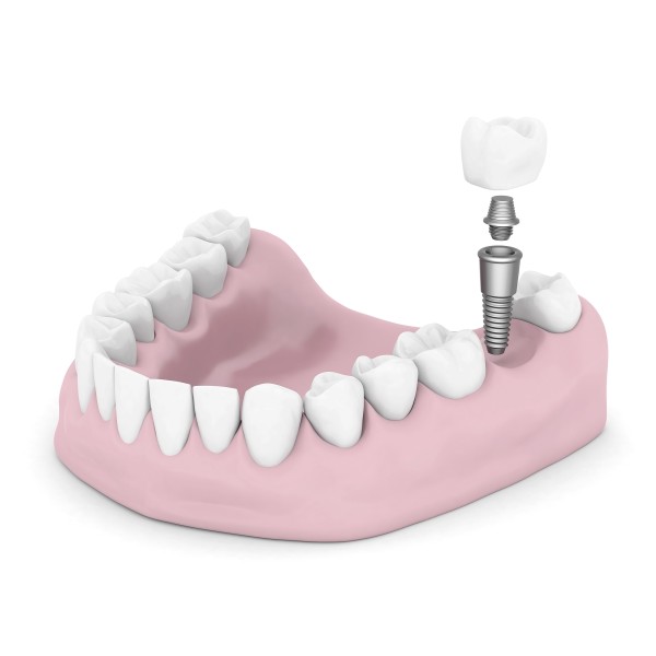Dental Implants in Cleburne