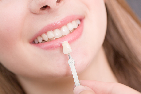 Dental veneers in Cleburne