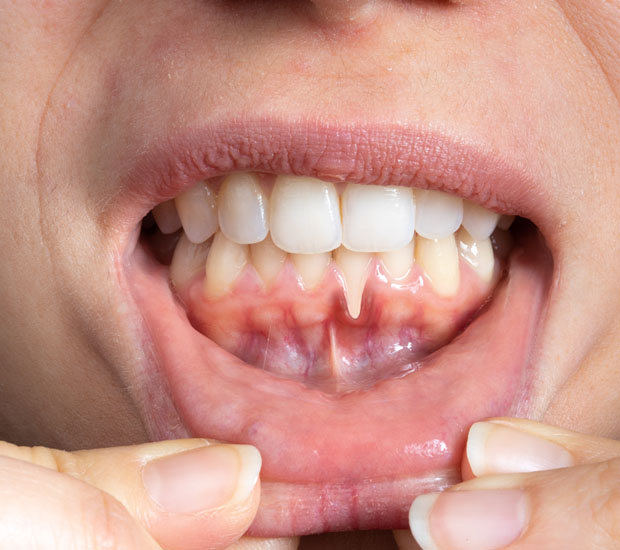 Cleburne I Think My Gums Are Receding