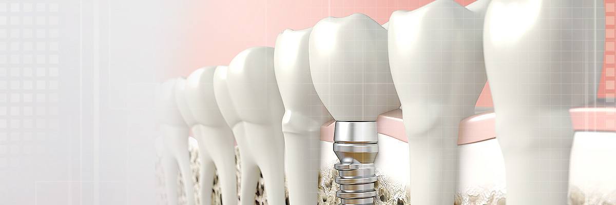 Cleburne Implant Dentist